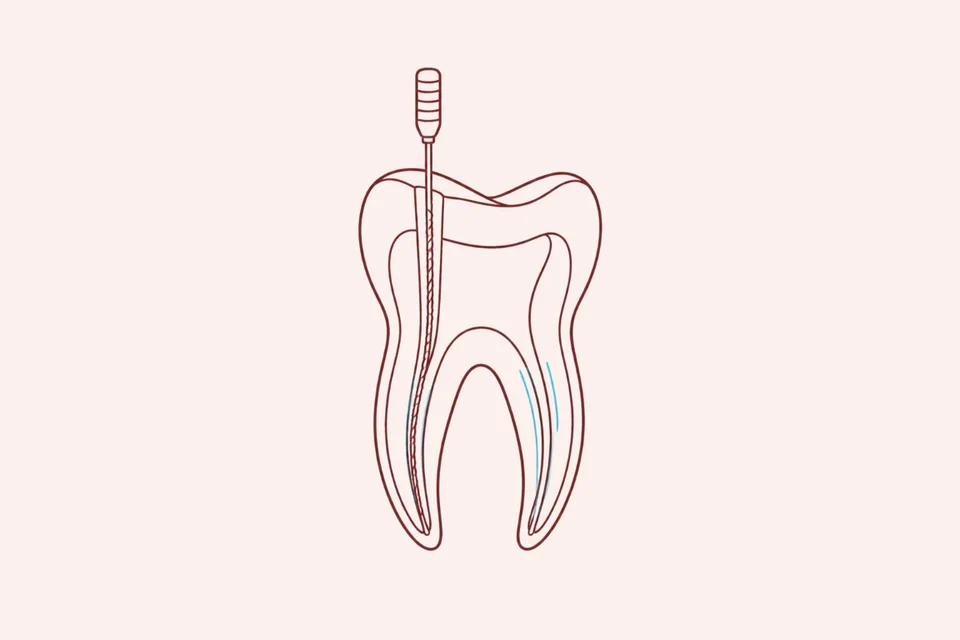 Ilustração de endodontia