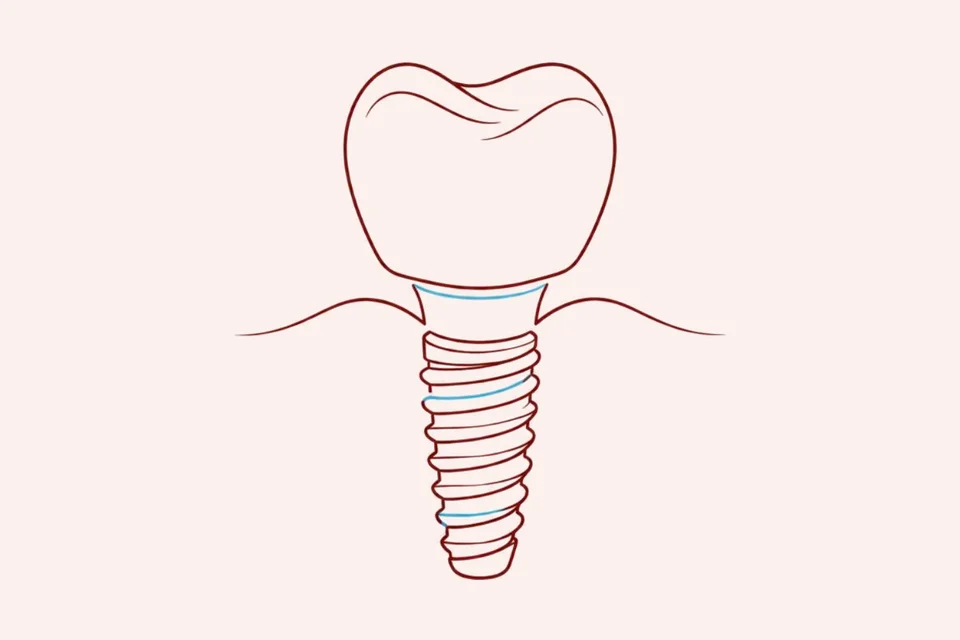 Ilustração de implantodontia