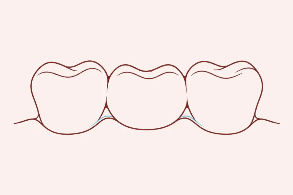 Ilustração de prótese dentária